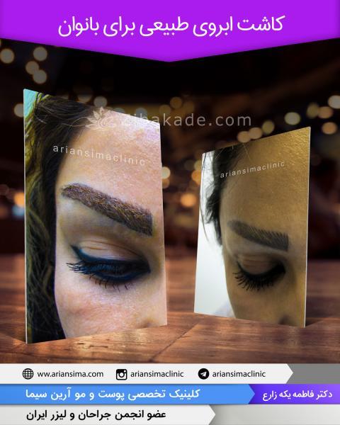 روند کاشت مو چگونه است 